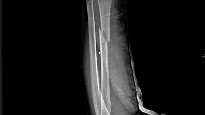Zdjęcie rentgenowskie potwierdzające, że w przypadku urazów kończyn nawet pojedynczym „śrutem” z rakiet GMLRS powstają złamania wieloodłamowe, których objętość znacznie przekracza wielkość elementu uszkadzającego